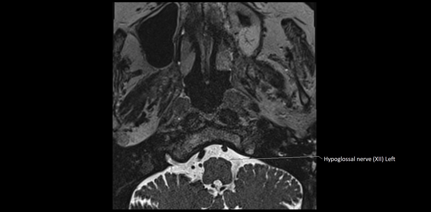 Cranial nerve anatomy axial MRI 3T image 76.webp
